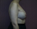 picture-breast-reconstruction-expander- 114m.jpg